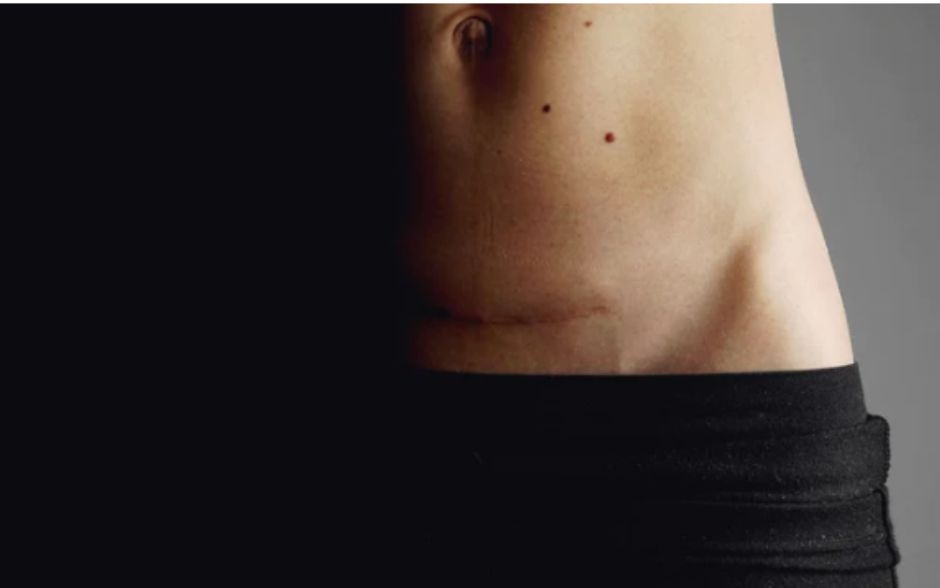 April is C-Section Awareness Month – Let’s Talk Tummies, Scars and Strength
